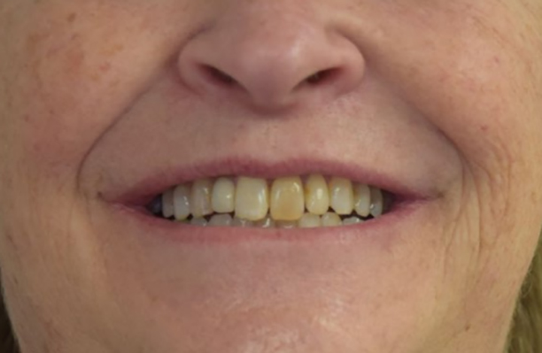 Cape Cod Dental | Full Mouth Reconstruction, Crowns  amp  Caps and Dentures