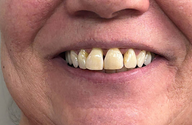 Cape Cod Dental | Implant Dentistry, Night Guards and Full Mouth Reconstruction