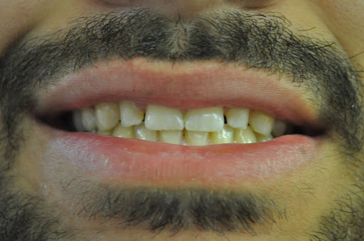 Cape Cod Dental | Ceramic Crowns, Fluoride Treatment and Root Canals